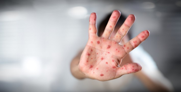 “Тенденція щодо рівня захворюваності на кір пішла на спад”, – Сергій Воронов