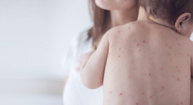 Черкащан закликають вакцинуватися від кору