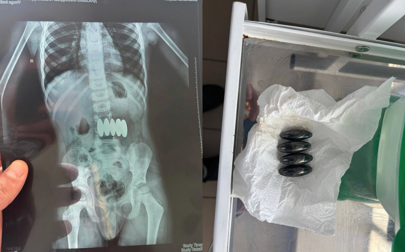 У Черкасах дитина проковтнула п’ять магнітів